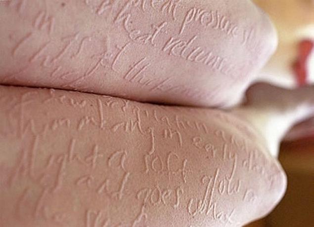 The Human Etch-A-Sketch: A “Skin Writer” Opens Up About Her Skin Condition