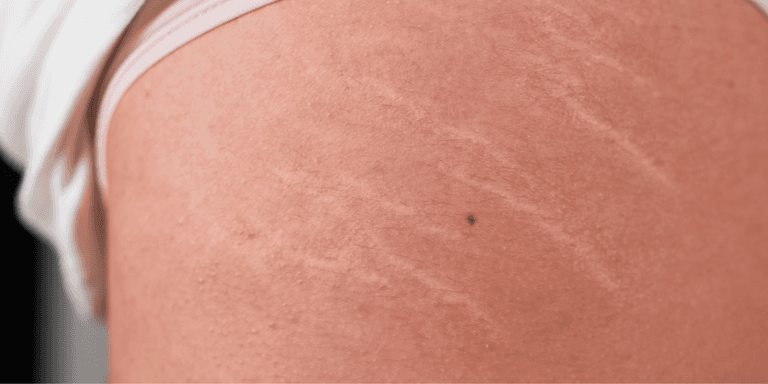 ‘Only two things work’ – Dermatologist reveals how to actually treat stretch marks ‘Only two things work’ – Dermatologist reveals how to actually treat stretch marks