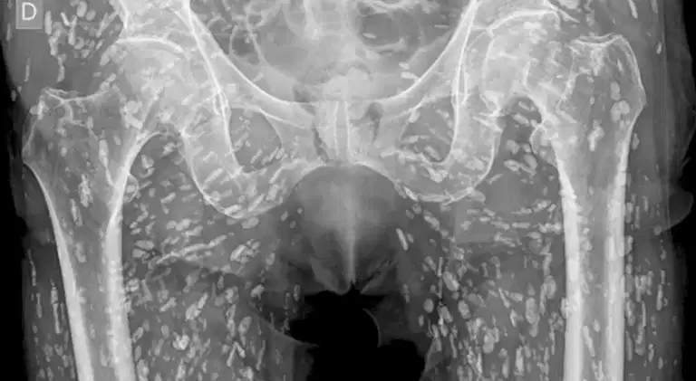 Horrifying X-ray shows tapeworms breeding inside man’s body after he made vital kitchen error Horrifying X-ray shows tapeworms breeding inside man’s body after he made vital kitchen error