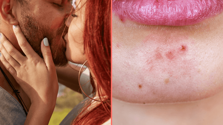 Expert issues grim warning to anyone who kisses bearded men Expert issues grim warning to anyone who kisses bearded men