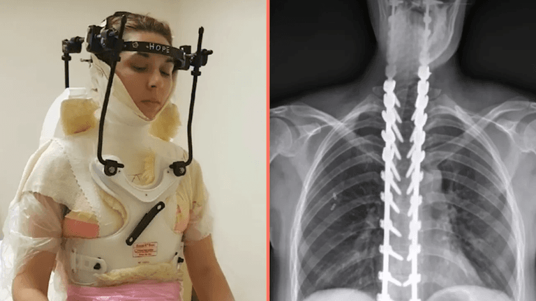 Woman has skull reattached after being ‘decapitated’ in freak football injury Woman has skull reattached after being ‘decapitated’ in freak football injury