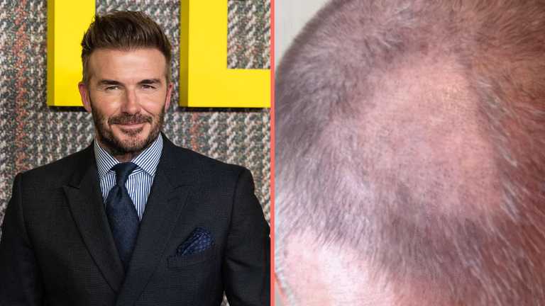 David Beckham left with ‘terrible’ bald patch after trying to cut his own hair David Beckham left with ‘terrible’ bald patch after trying to cut his own hair